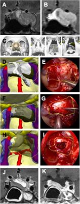 Narrative review of patient-specific 3D visualization and reality technologies in skull base neurosurgery: enhancements in surgical training, planning, and navigation